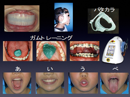 歯並びから考える子供の歯の健康
