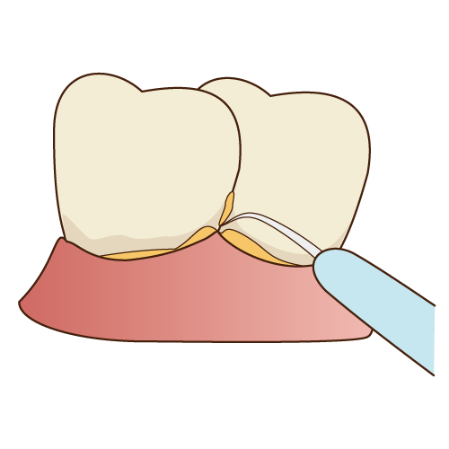 歯周病 歯槽膿漏 まぶち歯科医院 伏見区醍醐の歯科